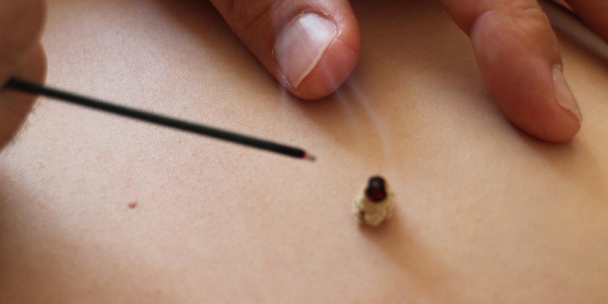 Other treatment methods include moxibustion - using a smouldering herb to warm acupuncture points